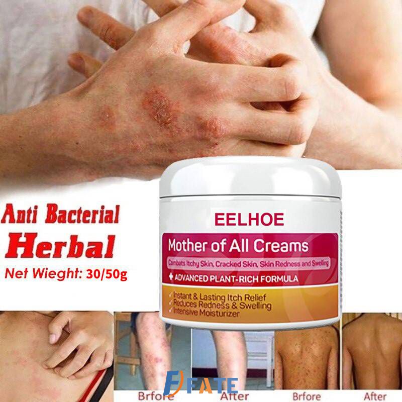 Eelhoe Skin Psoriasis Cream Dermatitis Eczematoid Eczema Ointment