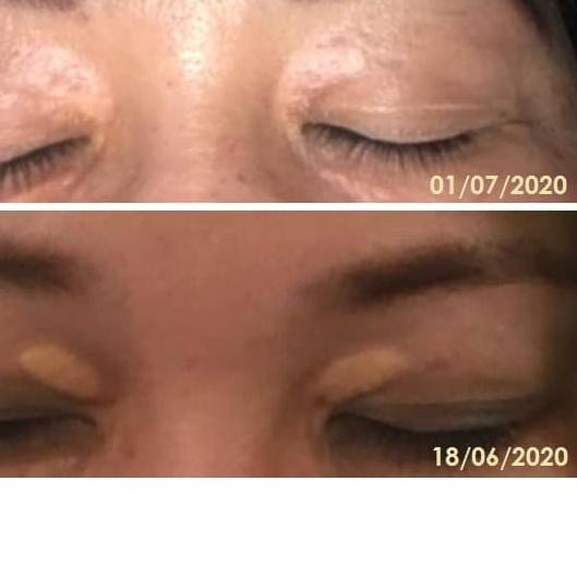 Xanthelasma Cream 10gr Shopee Malaysia