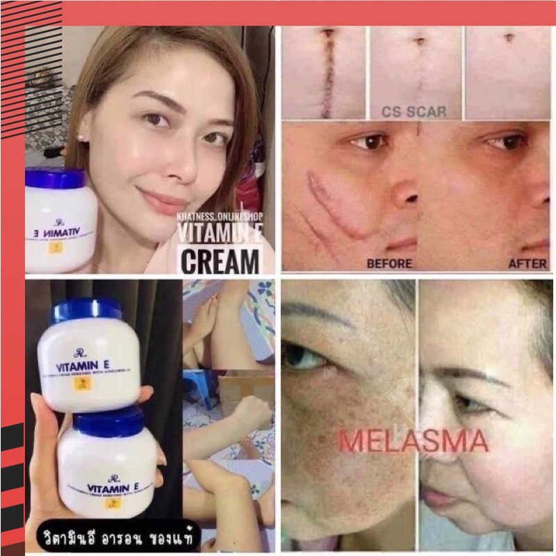 VITAMIN E CREAM DISAAR, putihkan kulit,hilangka pelbagai jenis parut Shopee Malaysia