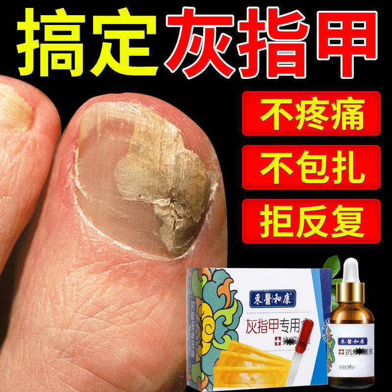灰指甲药 灰指甲特效药增厚快速治疗甲沟炎抑菌液软甲亮甲专用药灰甲净药水 Shopee Malaysia