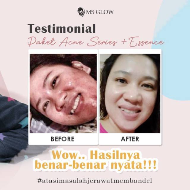 essence ms glow acne