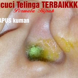 TELINGA BAIK 3 MINIT dgn Pencuci Telinga Permata Hijrah 