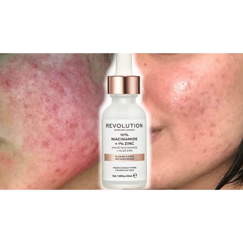 revolution skincare blemish zinc & niacinamide