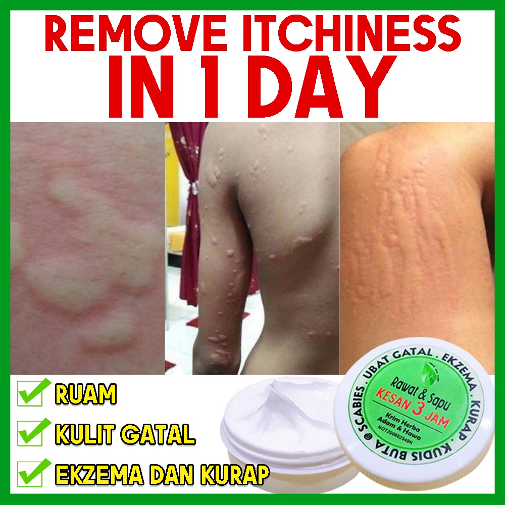 Krim Gatal Adam Dan Hawa Eczema Cream Krim Gatal Kulit Ubat Panau Ubat Kurap Ubat Gatal Psoriasis Cream Antifungal Cream Shopee Malaysia