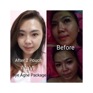 š„READY STOCKš„100%ORIGINAL HQ BLEMISH SERUM VAVL BEAUTY