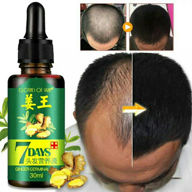 hair loss treatment malaysia