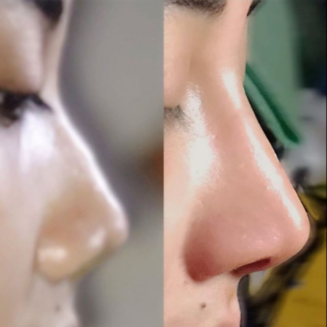 Kursus Filler Hidung Shopee Malaysia