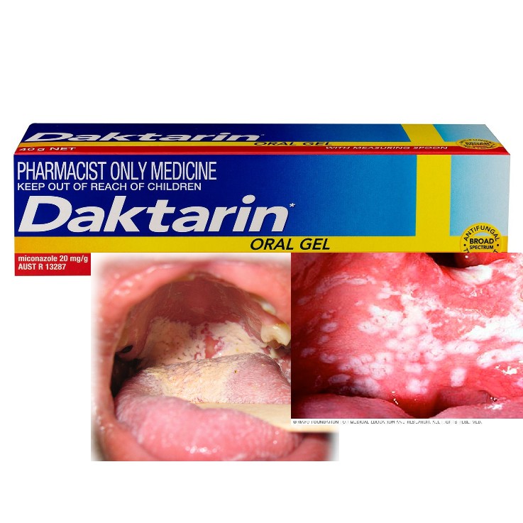 Daktarin Oral Gel 15g Shopee Malaysia