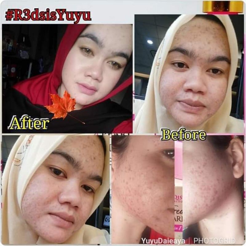 Hot Item Qisya Beauty Merawat Semua Masalah Kulit Muka Shopee Malaysia