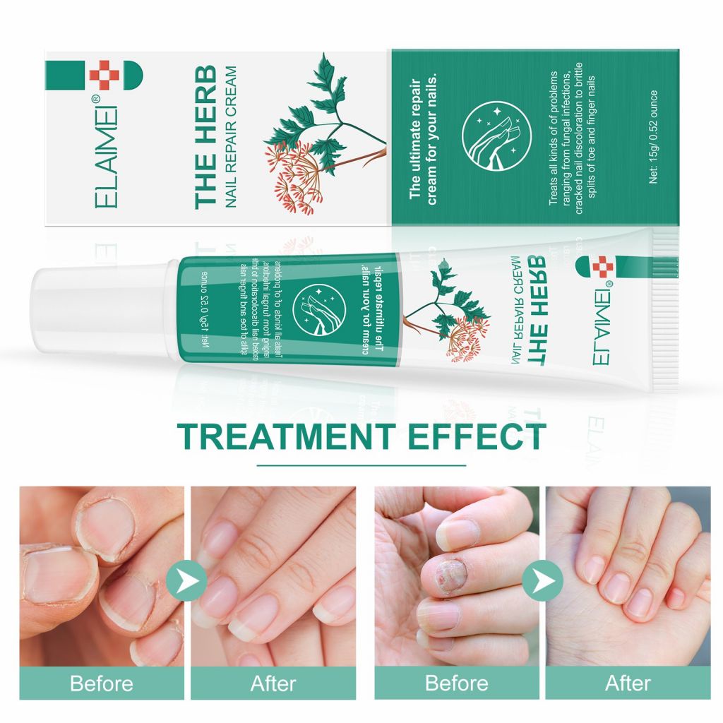 Nail Repair Cream Anti Fungal Cream Nail Fungus Treatment 20g Nail Repair  Cream Antifungal And Paronychia Treatment Onychomycosis Broken Treatment  Cream Lazada | 20g Nail Repair Cream Anti Infection Paronychia Grey Nail