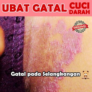 Ubat Gatal - Allergy , Cuci Darah , Celah Kangkang, Kurap 