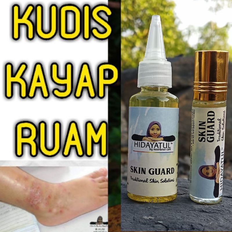 Ubat Kudis Kayap Gatal Ruam Bisul Ekzema Eczema Not Cream Krim Shopee Malaysia