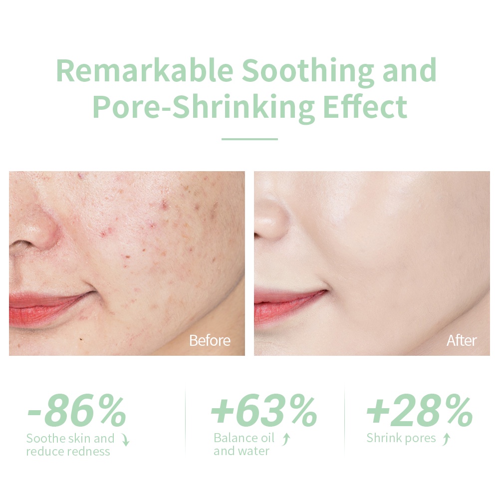 Reliable Multi LANBENA Acne Treatment Facial Toner Soothe Skin Control Oil Shrink Pores Suitable Acne-Prone (100ml) Q... - Image 4