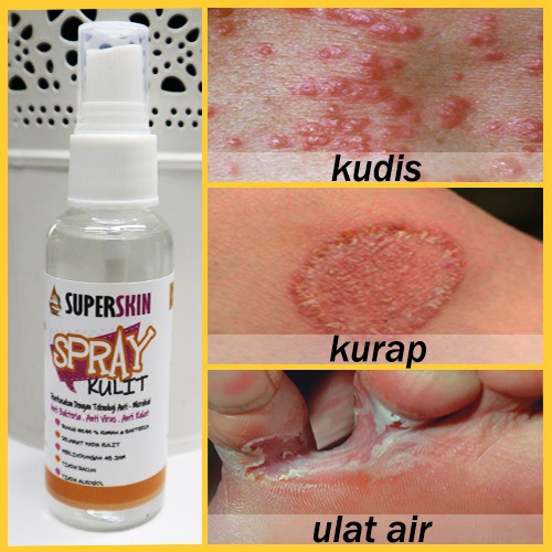 UBAT KURAP KUDIS PANAU🔥 Ruam Ekzema Kudis Psoriasis Scabies Itchy