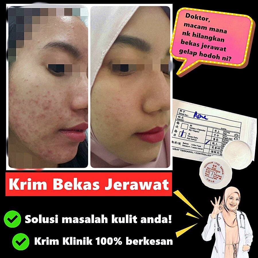 Ubat Jerawat Gel Anti Acne Hapus Jerawat Dan Parut Shopee Malaysia