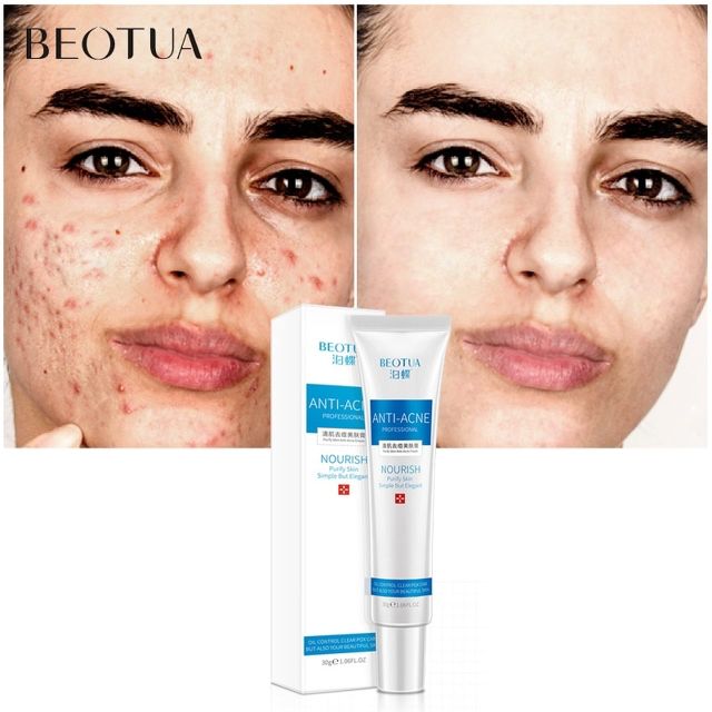 Beotua Tea Tree Acne Face Cream Anti Acne Treatment Shrink Pores Whitening Scar Removal G