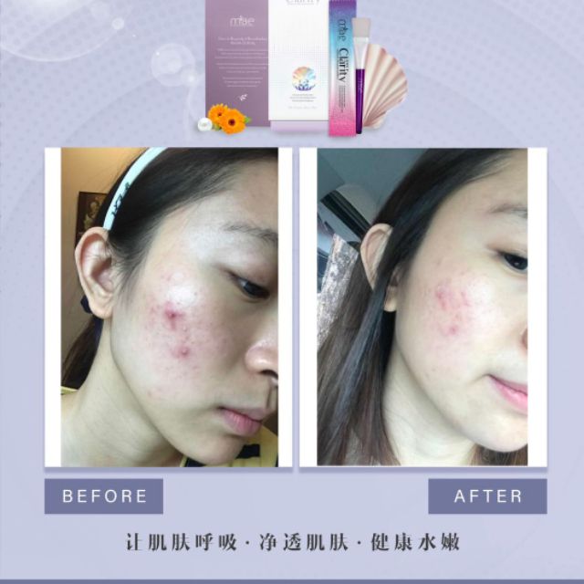 Mae Clarity Skin Detoxification Whitening Repair Skin Ance All Skin Type Can Use Shopee Malaysia