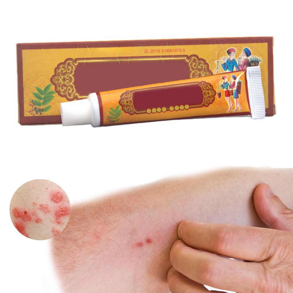 YWDH 1 Piece Treatment Dermatitis Eczema Hand Ringworm Antipruritic