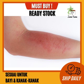 UBAT GATAL UBAT KURAP NATURAL ALOE VERA ANTIFUNGAL CREAM TUBE (5G