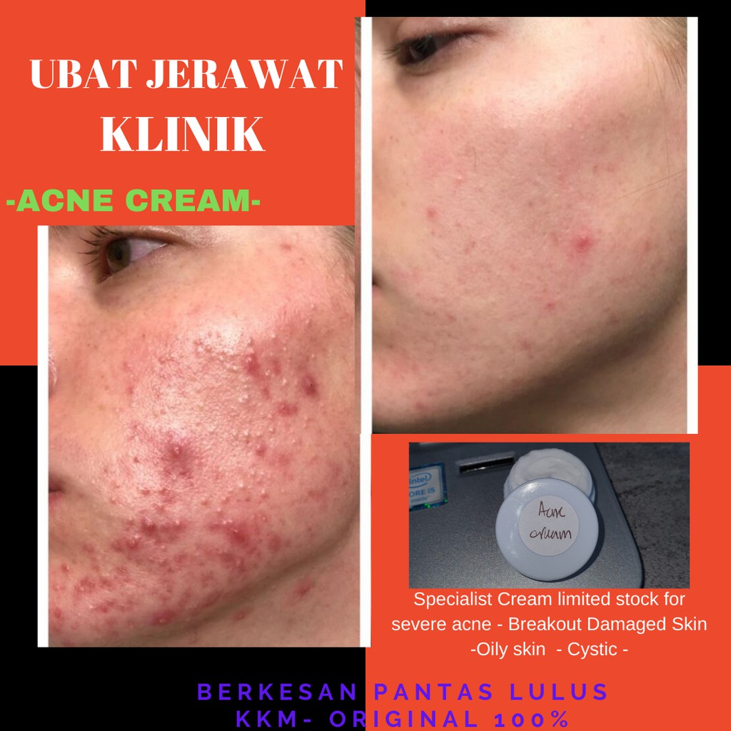 acne cream terbaik