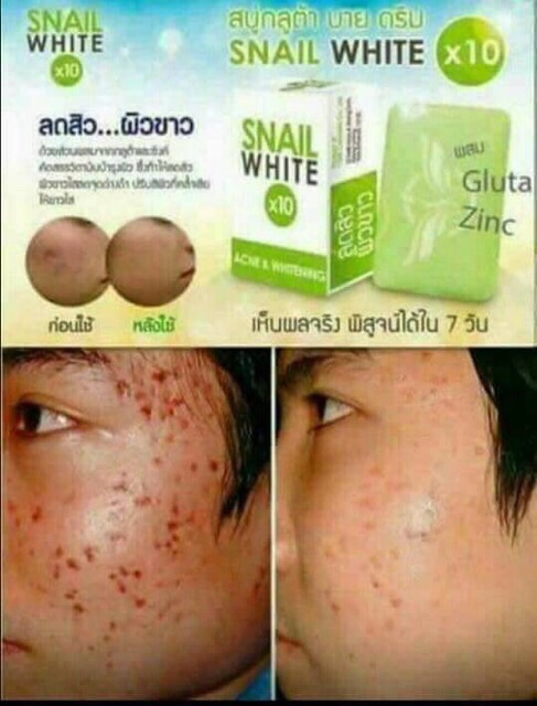 snail white acne soap benefits
