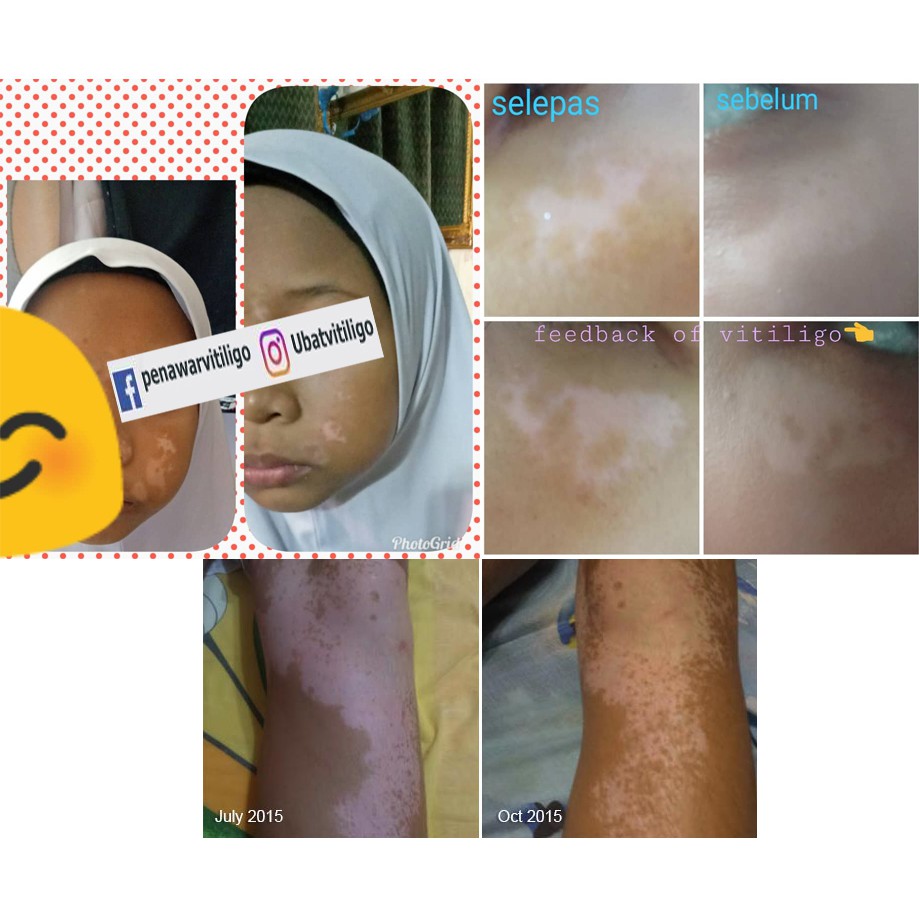Penawar Penyakit Sakit Sopak Vitiligo Vitiligo Organics Naturally Worldwide Melanin Plus Organics Kkm Registered Shopee Malaysia