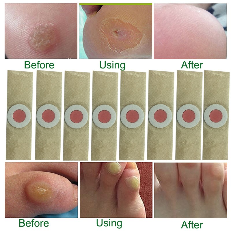 foot corn removal plaster