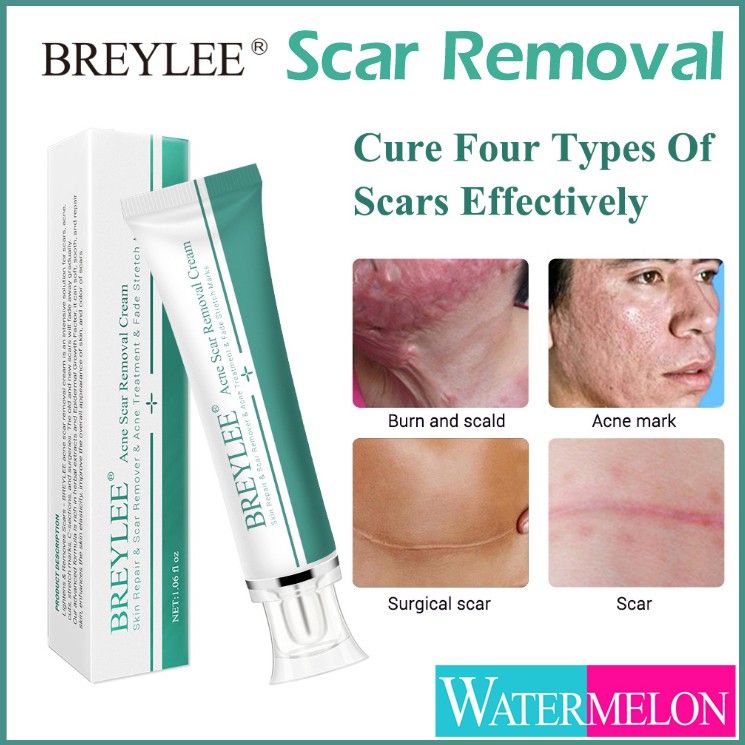 acne whitening cream