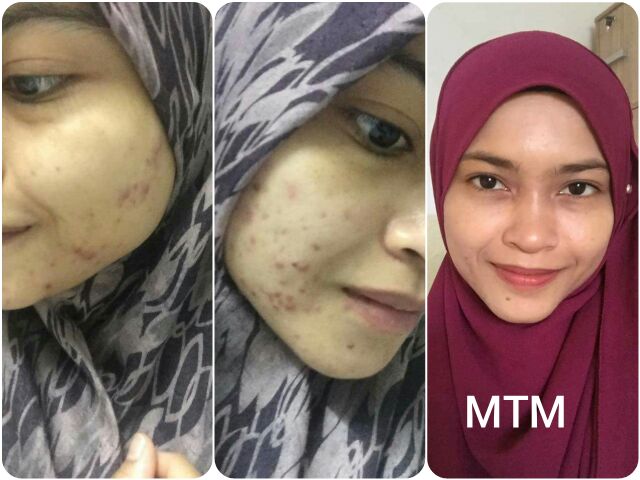 Ubat Jerawat Skincare Magic Tamarind Mask Mtm Jerawat Parut Berlubang Pores Scar Mask Skincare Parut Hitam Shopee Malaysia