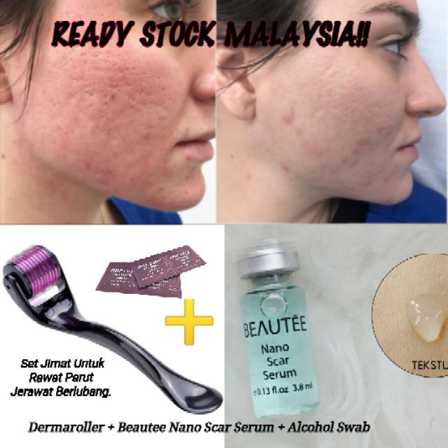 Serum untuk parut jerawat