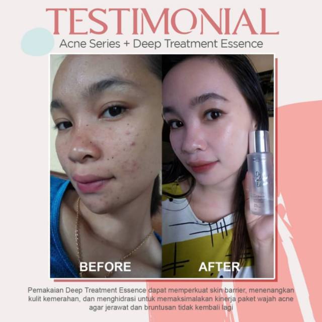 essence ms glow acne