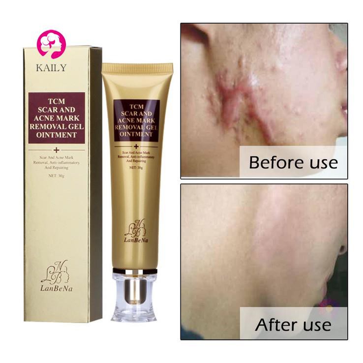 lion pair acne cream watson