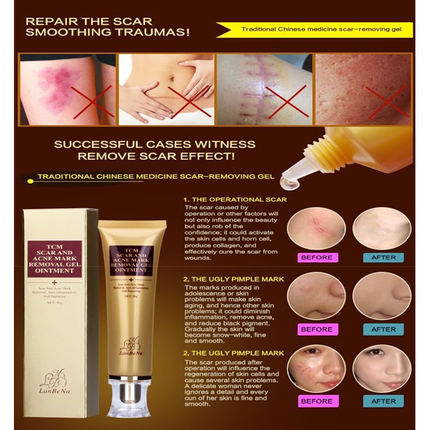 TCM Acne Scar Cream 痤疮疤痕去除霜
