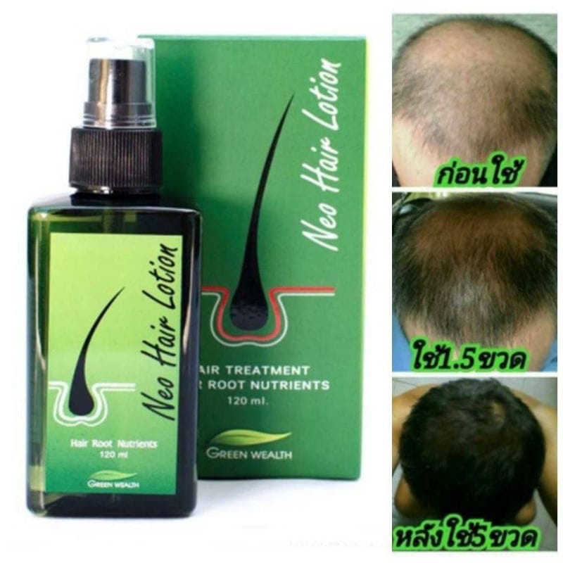 Neo Hair Lotion Hair Growth Solution 100 Original Thailand Shopee