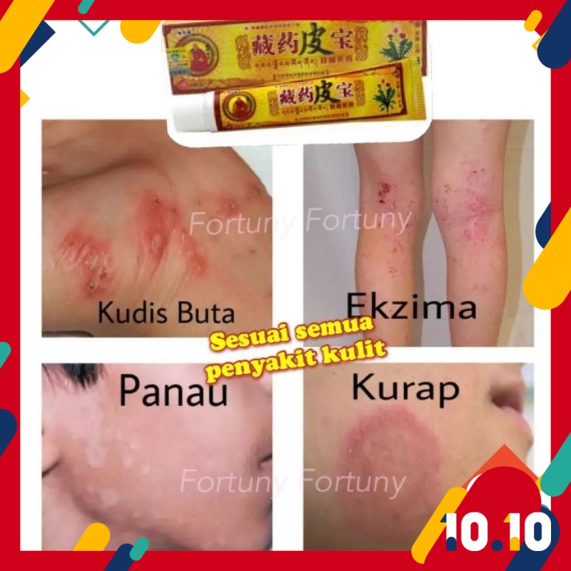 15g Chinese Herbal Krim Kuning Ubat Ekzema Kurap Panau Gatal Kulat Eczema Creamèè¯ç®å® Shopee Malaysia