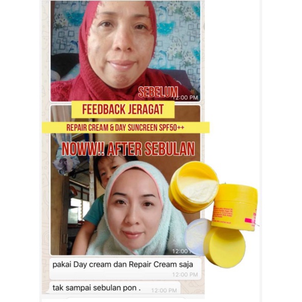 Buy Ori Krim Hilangkan Jerawat Jeragat Breakout Parut Kusam Free Seetracker Malaysia