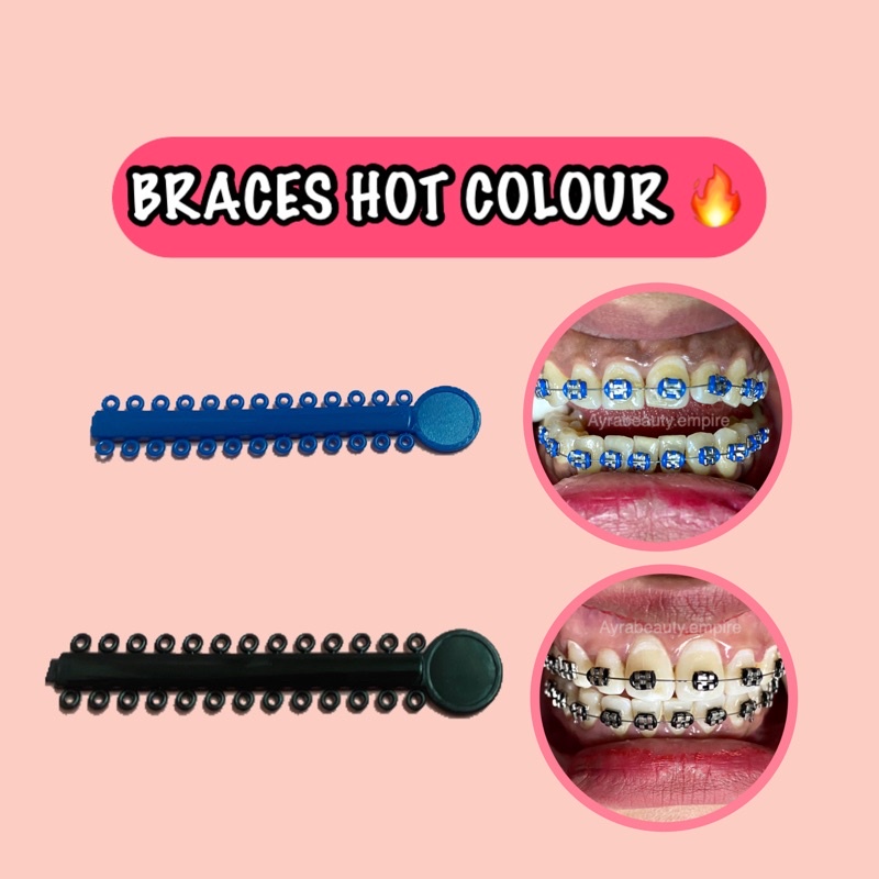 Buy 1 Stick 26 Pcs Hot Colour Getah Braces Ligature Ties Dental Orthodontic Power O Servis Teeth Whitening Gigi Tiktok Viral Seetracker Malaysia
