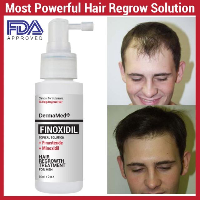 Minoxidil finpecia 1mg