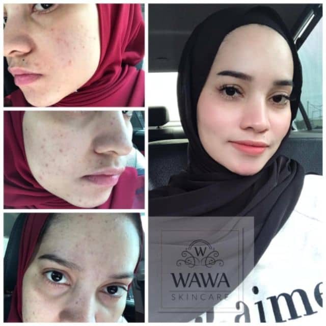 Wawa Skincare 5 In 1 Jwr Skincare 5 In 1 Lulus Kkm Set Kecantikan Wajah Skincare Viral Shopee Malaysia