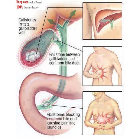 Ubat Batu Karang PUNDI KENCING, HEMPEDU & KIDNEY STONE 30 