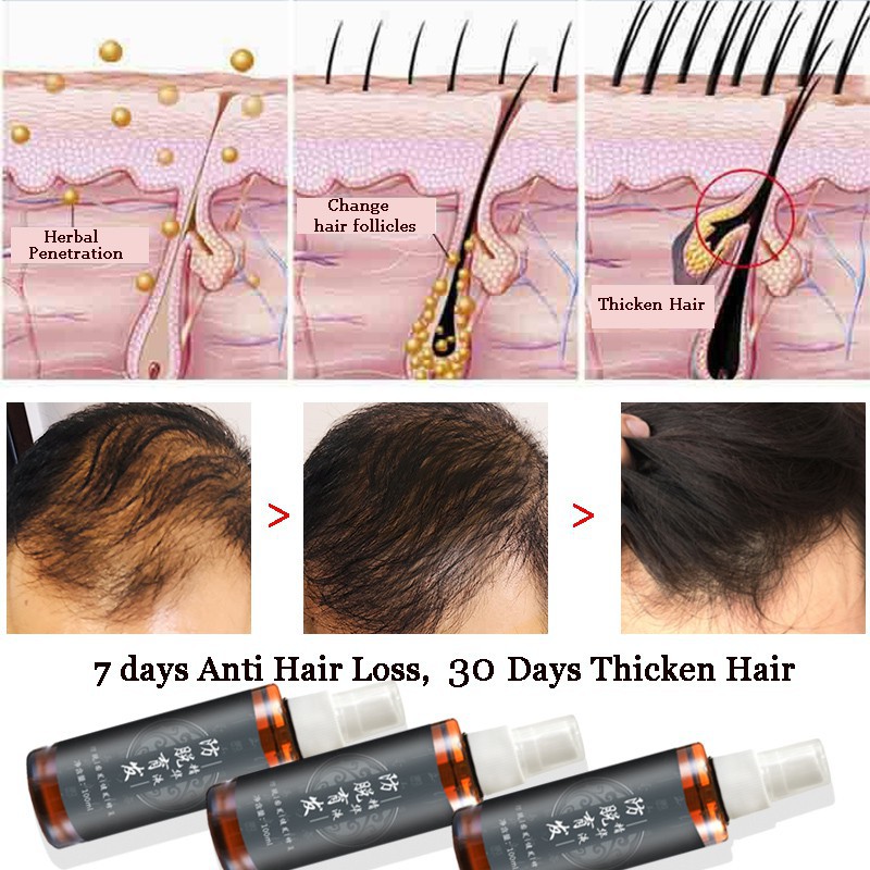 Herbal Essence Fast-promoting Hair Growth Serum Improve Hair Follicle  Nourishing Hair Root Fall Treatment Spray | Shopee Malaysia