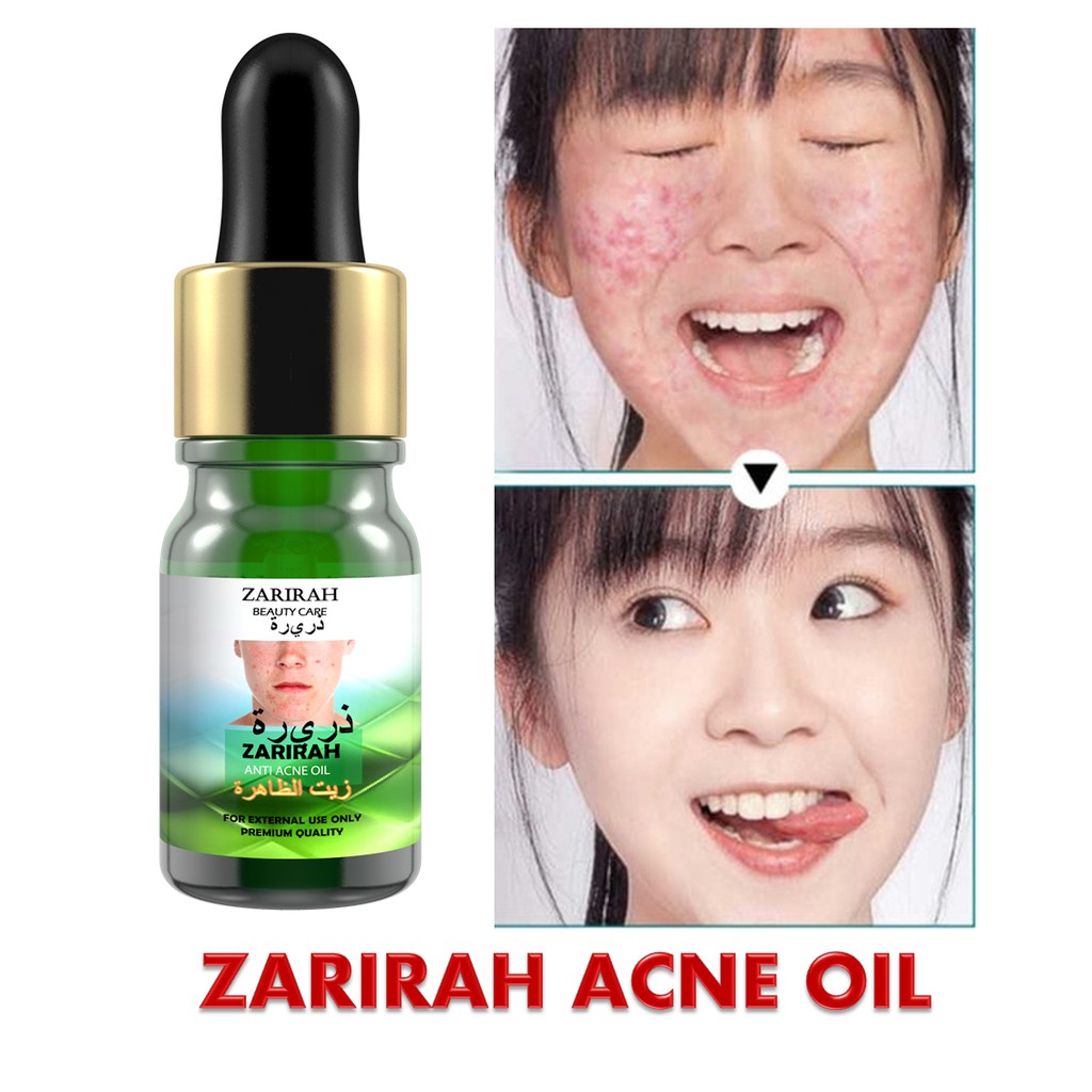 Zarirah Acne Oil Dzarirah Minyak Kecutkan Jerawat 5ml Extra Gift Shopee Malaysia