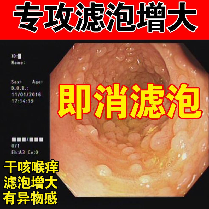 Quality To You Guarantee Penyembuhan Mulut Menyegarkan Tekak Faringitis Akut Dan Kronik Gatal Kering Batuk Dahak Shopee Malaysia