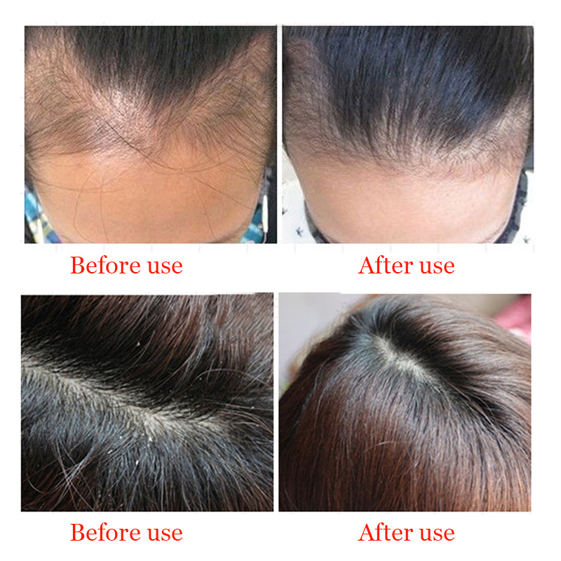 30ML Hair Growth Essence Oils Advanced Thinning Hair & Hair Loss Supplement  Beauty Support Anti-off Hair Solution | Shopee Malaysia