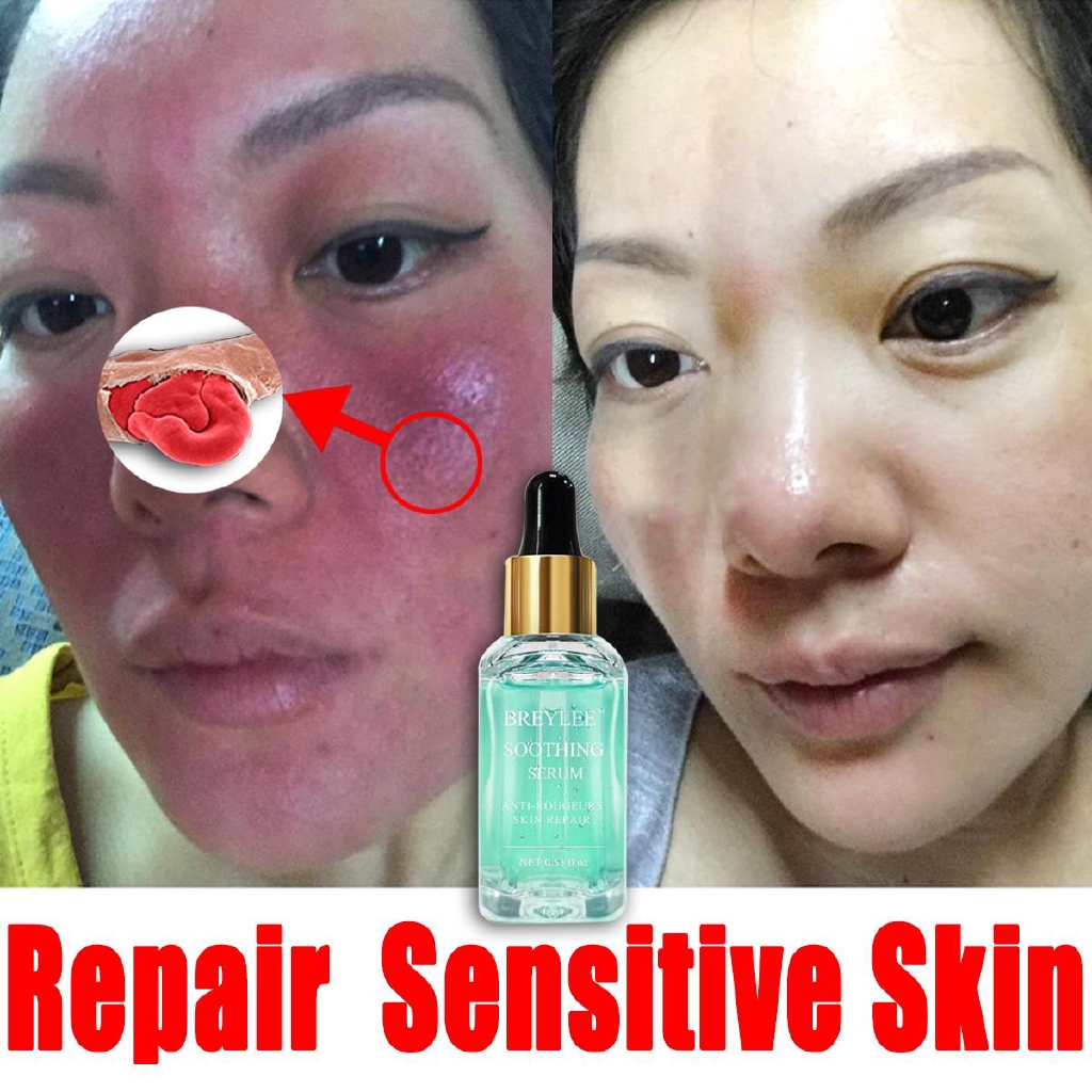 sensitive skin acne