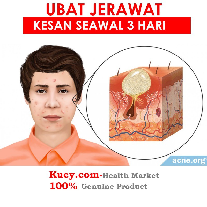 Ubat Jerawat Untuk Jerawat Muka Jerawat Batu Acne Treatment Cure 15 G Shopee Malaysia