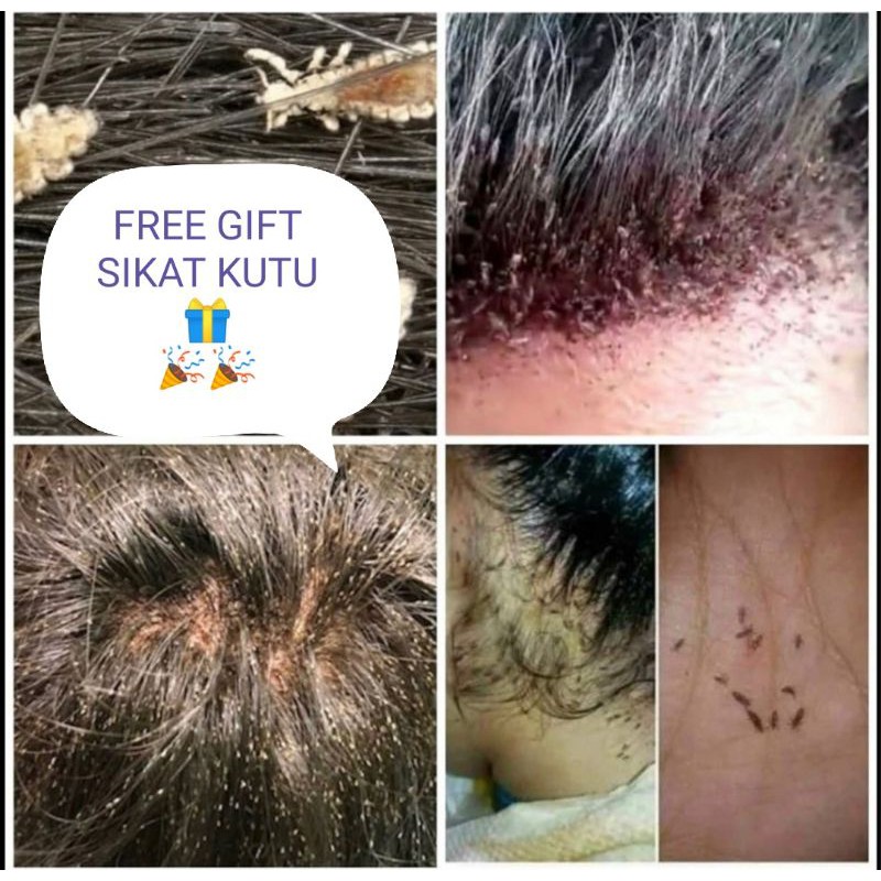 Ubat Kutu Power Spray Kutu Kepala Natural Kutu Rambut Ubat Kutu Kepala Natural Spray Kutu Rambut Flea Spray Shopee Malaysia