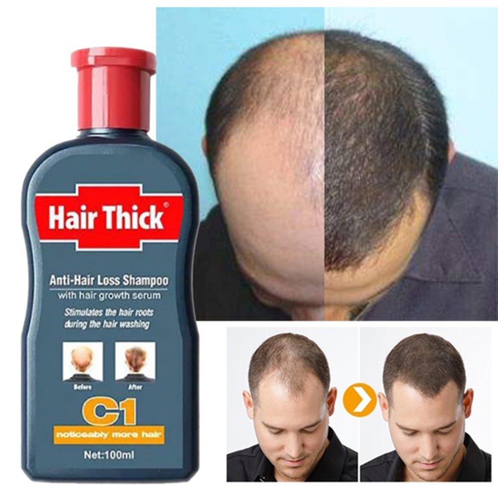 Hair Loss Shampoo Hair Growth Treatment Oil Control Anti Dandruff