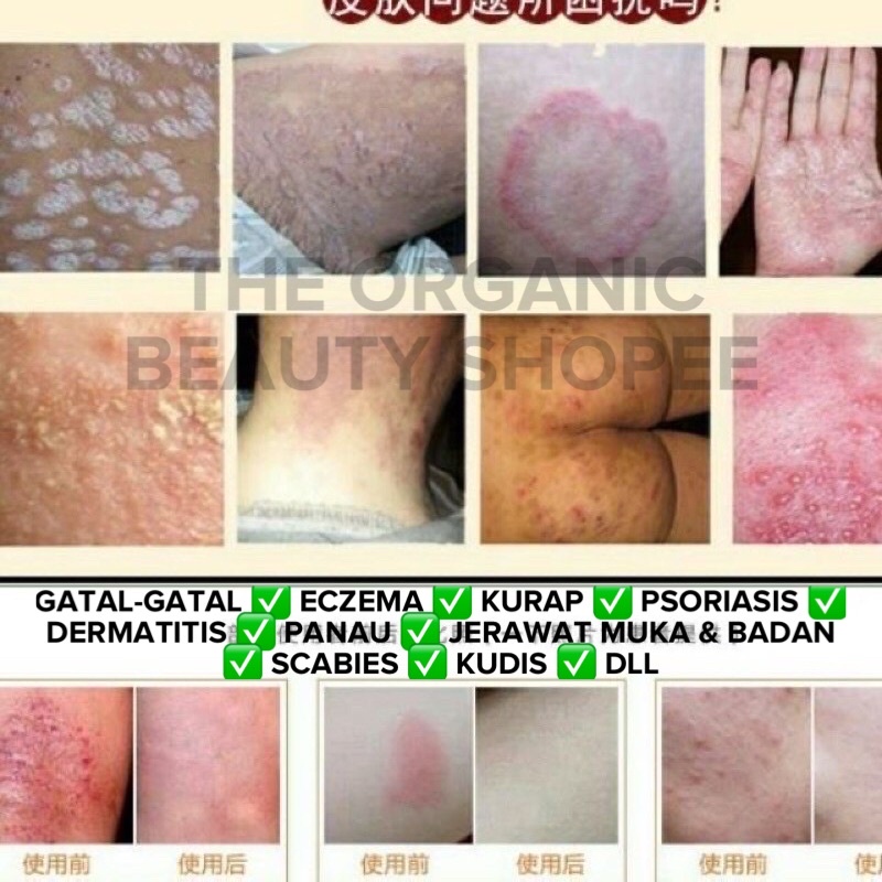 Readystock Original Ubat Gatal Mujarab Ubat Gatal Ubat Kurap Mujarab Krim Eczema Mujarab Pos Setiap Hari Shopee Malaysia