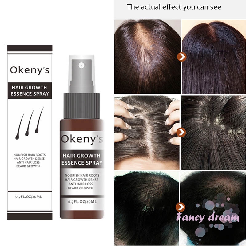✿FD✿ Ginger Hair Growth Essence Spray 20ml Hair Grow Restoration Oil  Prevent Baldness | Shopee Malaysia
